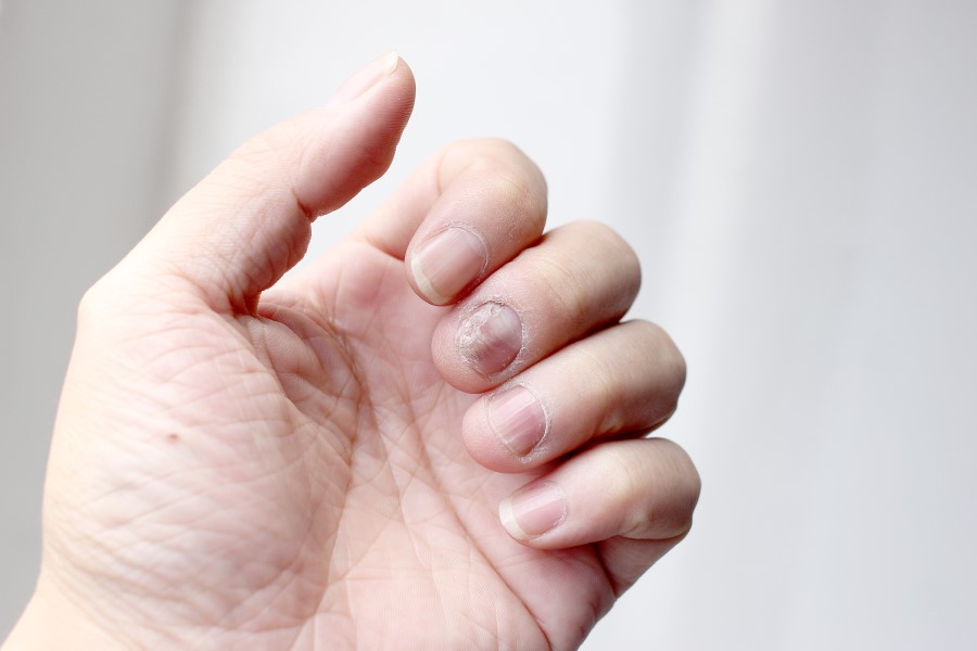 Zbliżenie na dłoń z widoczną drożdżycą paznokci na środkowym palcu.