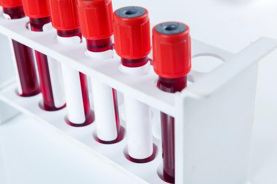 Fiolki zawierające krew do badania morfologii krwi, w tym wskaźnika PDW.