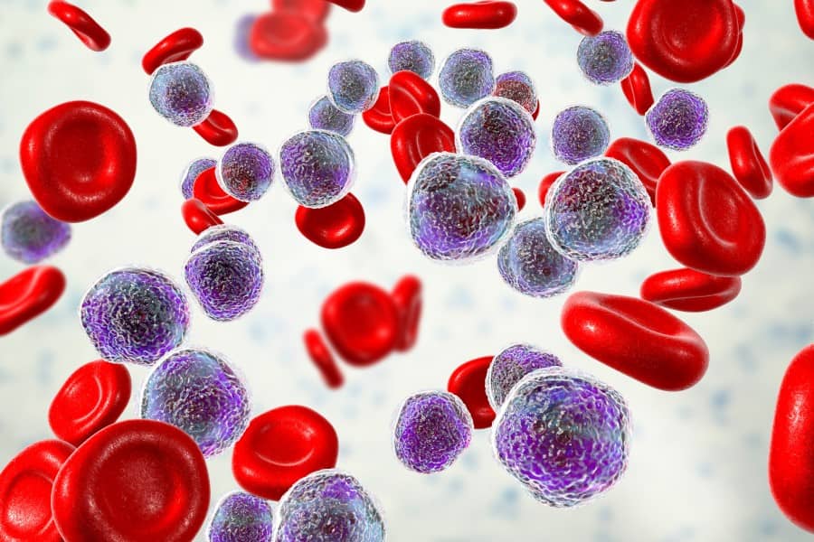 Elementy morfotyczne krwi w przebiegu białaczki.