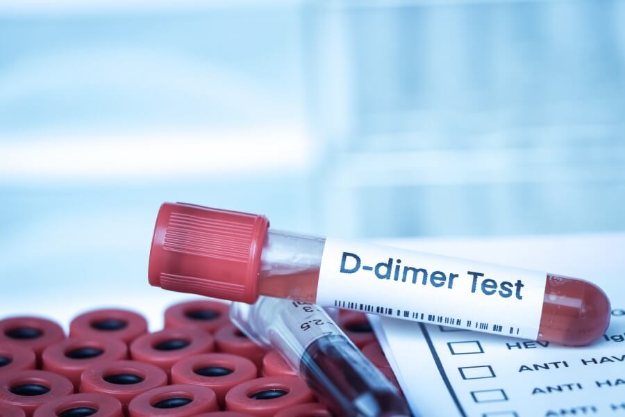 Fiolka krwi pacjenta przeznaczona do badania stężenia d-dimerów.