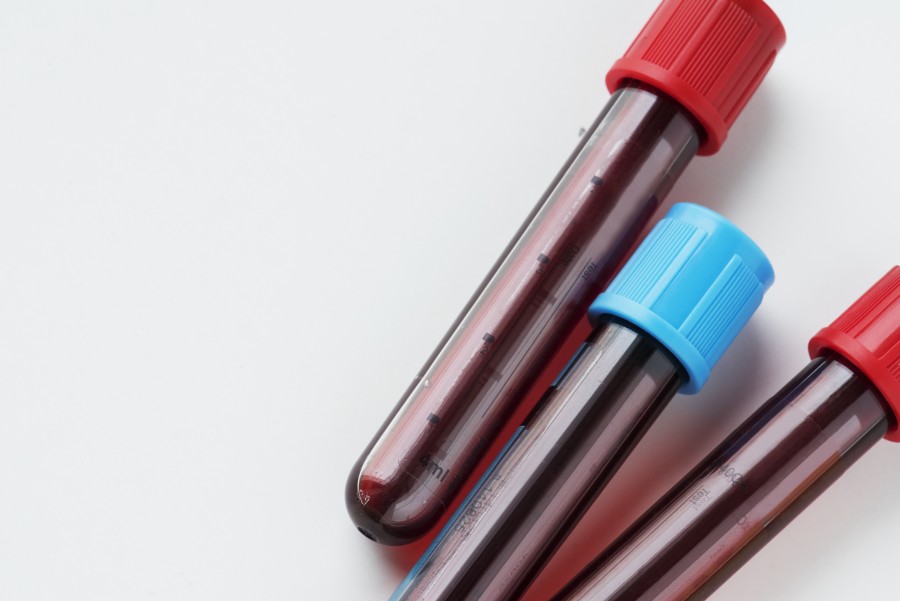 Mocznik we krwi – jakie są normy? 