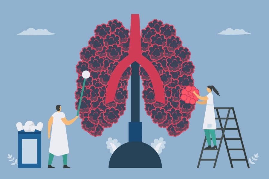 Grafika 2D ludzkich płuc z objawami rozedmy płuc.