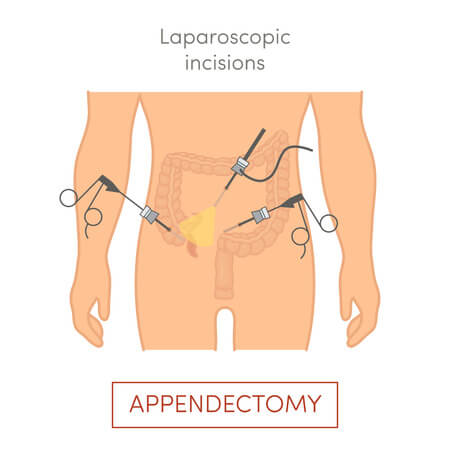 wyrostek robaczkowy laparoskopia