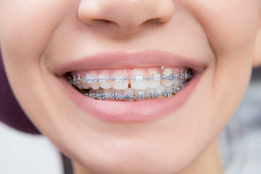 Zbliżenie na kobiecy uśmiech. Na zębach jest widoczny aparat ortodontyczny.