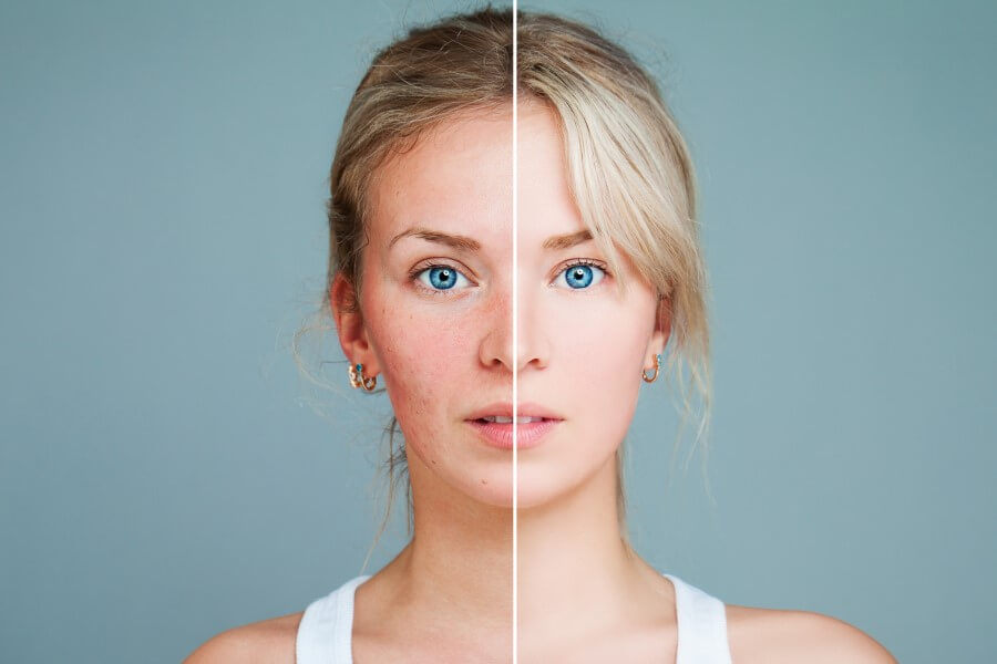 Zdjęcie twarzy kobiety, podzielone. Po lewej stronie cera podrażniona, po prawej zdrowa.