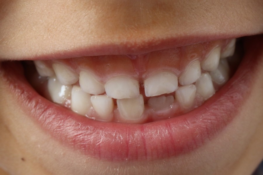 Czy warto leczyć zęby mleczne?