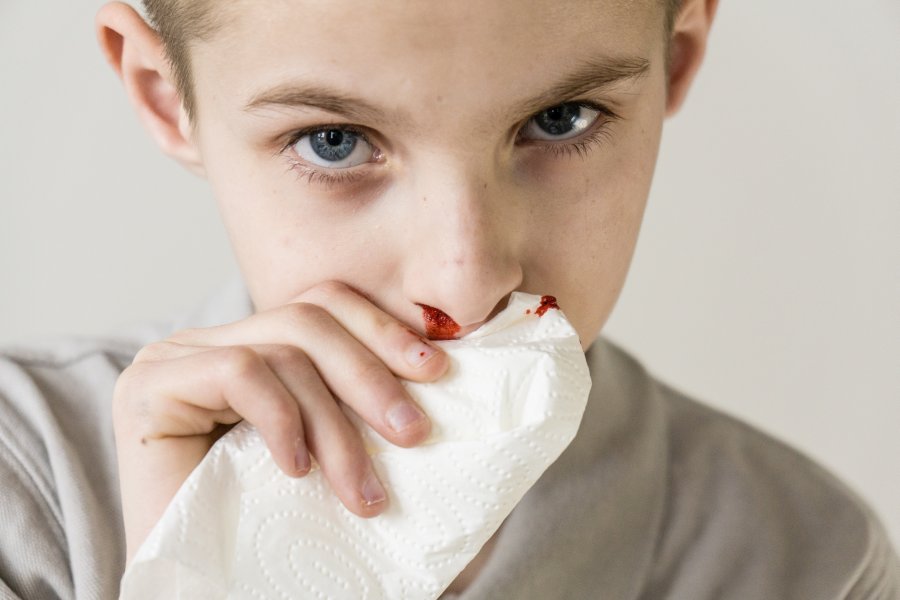 Chłopiec tamuje chusteczką krwotok z nosa