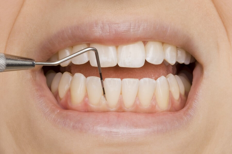 Zęby pacjenta podczas badania zgłębnikiem.